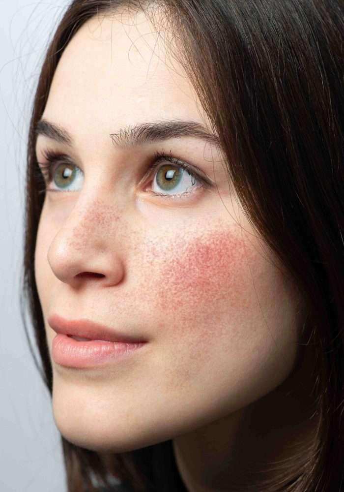 Face of a young woman with red cheeks suffering from acneiform rosacea, also called couperose. Dermatological problem that causes redness of the skin